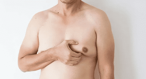 Qual a diferença entre Ginecomastia glandular e gordura nas mamas